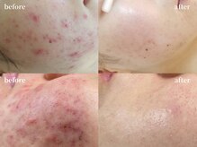 モトリヒ(Motorihi)の雰囲気（ニキビ/毛穴/赤みの状態を見極め、繰り返さないニキビ改善ケア）