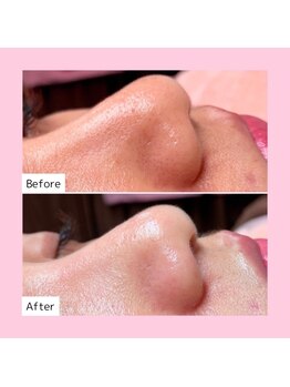 ホワイトラボ 岸和田店(White labo)/【施術例】ハイドロ毛穴洗浄