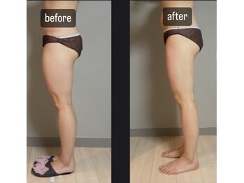 エヌボーテ(N. beaute)/before→after下半身4回目