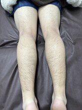 ビーンズ(BEANS)/脚脱毛