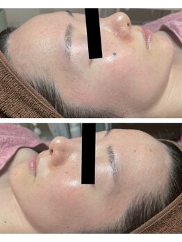 リラクゼーションサロン ラキ(laki)/お肌を育てるピーリング