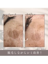 モアトゥインクル 山口店(MORE twinkle)/お顔脱毛は美白に効果的！