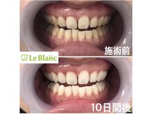 ルブラン 奈良店(Le Blanc)/照射回数を重ねてどんどん白く