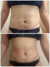 エルール トータルビューティ(Aileure total beauty)/ダウンタイムケアインディバ