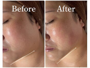 サラスヴァティー(SARASVATI)/二重あご/たるみ改善★30代女性