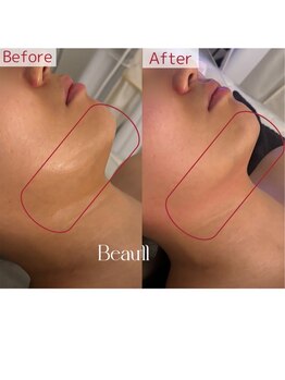 美温(mion)/レッドショット 脂肪分解