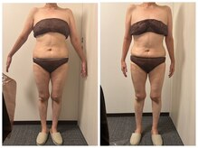 ラキ(LAKI)/痩身ビフォーアフター　60分