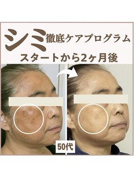 スイッチ(Switch)/皮膚科医監修コスメ使用2ヶ月で!