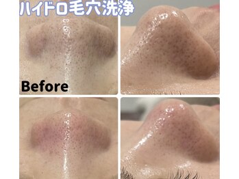 アリュールビューティー 下高井戸店(ALLURE BEAUTY)/黒ずみ毛穴洗浄