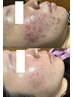 【本気で変えたい。大人肌へ】臍帯x羊膜のWパワーでつるもち水光肌へ♪