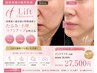 リフトアップ/小顔【イットリフト】フェイスライン引き締め|頬たるみ|目元