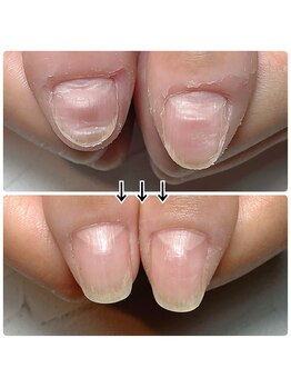 親指の横溝も改善