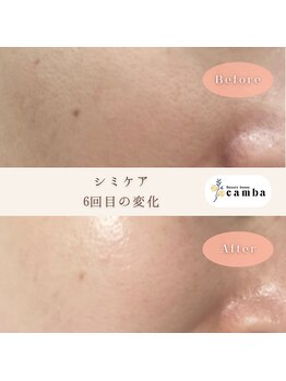 カンバ(camba)/【シミケア】Before→after