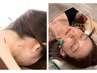 【女性人気◎】部分鍼灸+スタンダード美容鍼
