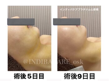 インディバケアプラチナム 心斎橋/