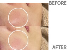 ライム 天神(LIME)/症例写真｜お肌の赤みケア