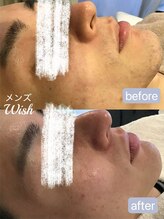 メンズ脱毛 ウィッシュ(Wish)/ヒゲとたるみケア＆つや肌に☆