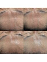 トゥインクル(Twinkle)/ララピールで気になる線を…