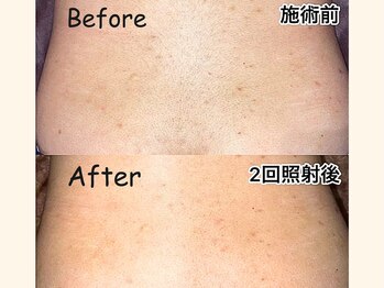 パッパ(PAPPA)/産毛もプロの目線でケア♪