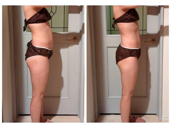 ヨサパーク アカーシャ(YOSA PARK AKASHA)/ぽっこりお腹のお悩み