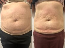 ラキ(LAKI)/痩身ビフォーアフター　40分