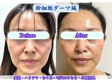 フラット柏(FLAT柏)/幹細胞ダーマ鍼・50代女性【柏】