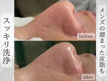 ライリー(Rairy)/【メンズ】プラズマ＋毛穴洗浄♪