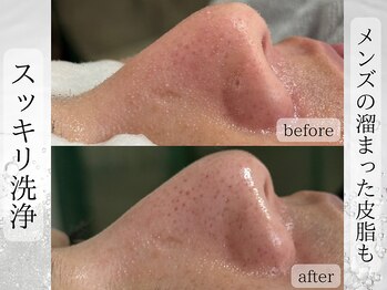 ライリー(Rairy)/【メンズ】プラズマ＋毛穴洗浄♪