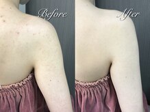 スリリアン 銀座/★ニキビ劇的ビフォーアフター★