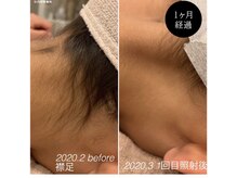 フローレント(Florent)/うなじ脱毛