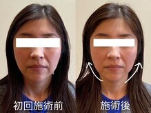 すわ鍼灸整骨院/1回の施術効果♪