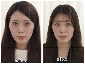 アキュモンド 渋谷院(acumond)/クイック美顔鍼コース3回の変化