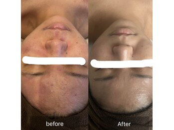 ア ルフレ(A.reflet)/before after