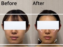 ベール(BEHL)/コルギのBefore After