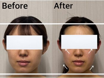 ベール(BEHL)/コルギのBefore After