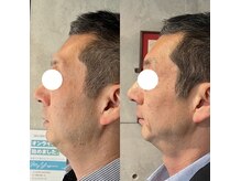 【オーダーメイド小顔術】老若男女問わず結果を出す技術と施術！