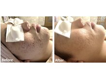 フーラ バイ アングラーズ(fu-ra by ANGLERS)/【光フェイシャル】ニキビ改善