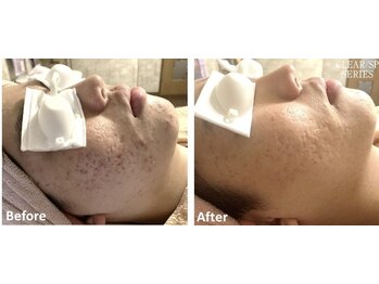 フーラ バイ アングラーズ(fu-ra by ANGLERS)/【光フェイシャル】ニキビ改善