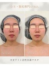 アトリア(ATRIA)/ゼオライト活性水素マスク