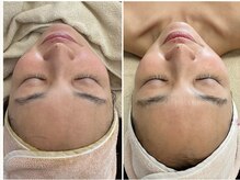 マヴィ 香里園店(MavY.)/ノンニードル水光注入☆