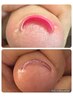 Foot【巻き込んだ爪でお悩みの方へ】ジェルで巻き込んだ爪の緩和(2本分)