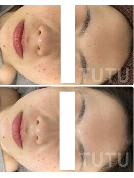 チュチュ(TUTU)/美白ケア