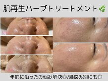 グロウ バイ フェイシャルデザイン アンド アイ(GROW)の雰囲気（何をしても改善されなかったお肌悩みを解決できる再生ハーブ♪）