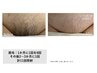 【女性】VIO脱毛　60分　￥5,000