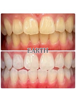 アース(EARTH)/【ビフォーアフター】美白