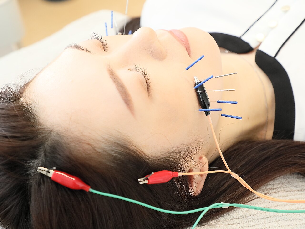 【鍼灸施術】身体の状態に合わせた鍼灸施術・効果実感◎