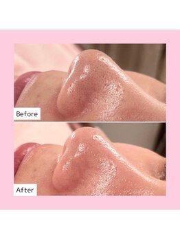 ホワイトラボ 岸和田店(White labo)/【施術例】ハイドロ毛穴洗浄