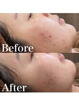 アマリリス(Amaryllis)/ハーブピーリングBefore/After