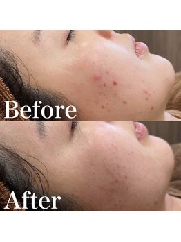 アマリリス(Amaryllis)/ハーブピーリングBefore/After