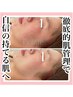新規様必見！【毛穴ケア・肌質改善】幹細胞ハーブピーリング ¥15400→¥ 11000